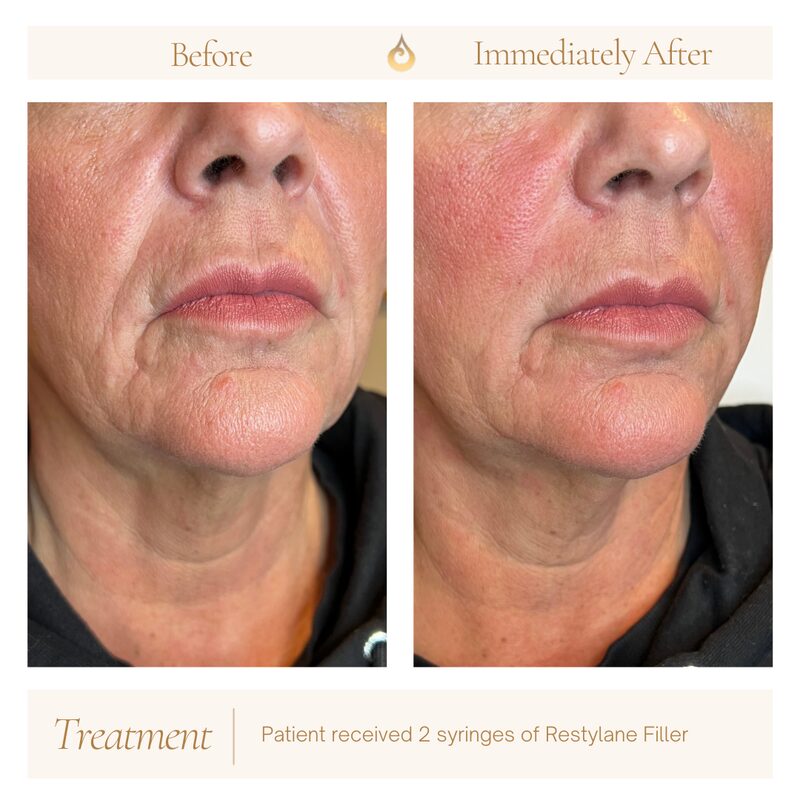 Dermal Filler, before and after
