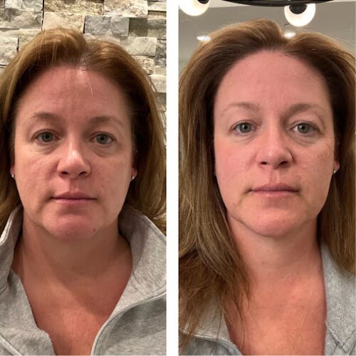 Face Rejuvenation, before and after